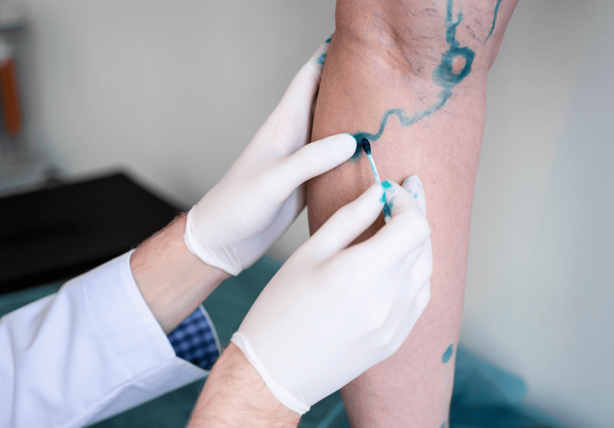 Vista em primeiro plano de um procedimento de marcação cirúrgica vascular. Mãos com luvas brancas de um profissional de saúde, vestindo jaleco, utilizam um cotonete aplicador para traçar com tinta azul o trajeto de uma veia varicosa calibrosa e tortuosa na perna de um paciente, em um ambiente de consultório médico.